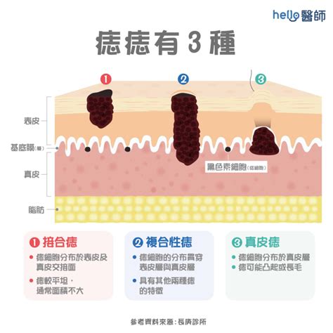 臉突然長痣|痣形成的原因？痣長毛、痣變多變大是痣病變？5招判。